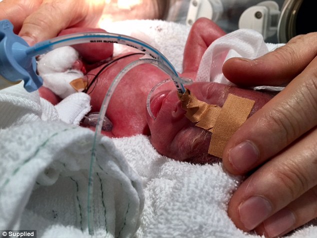 超坚强！澳“奇迹”宝宝早产超15周仅639克