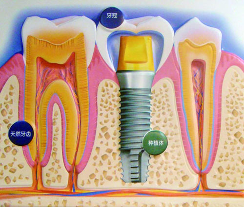“3D打印牙”将开始临床试验