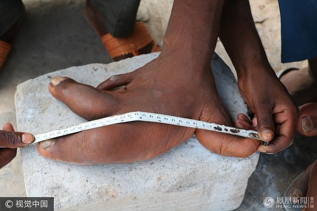 印度12岁男孩患罕见怪病 手掌长似芭蕉叶